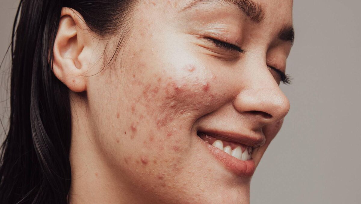 Products aimed at acne-sufferers are notoriously expensive 