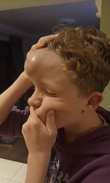 Some of the medics who treated Jack said they had never seen a haematoma like it in their lives. Some of the medics who treated Jack said they had never seen a haematoma like it in their lives.