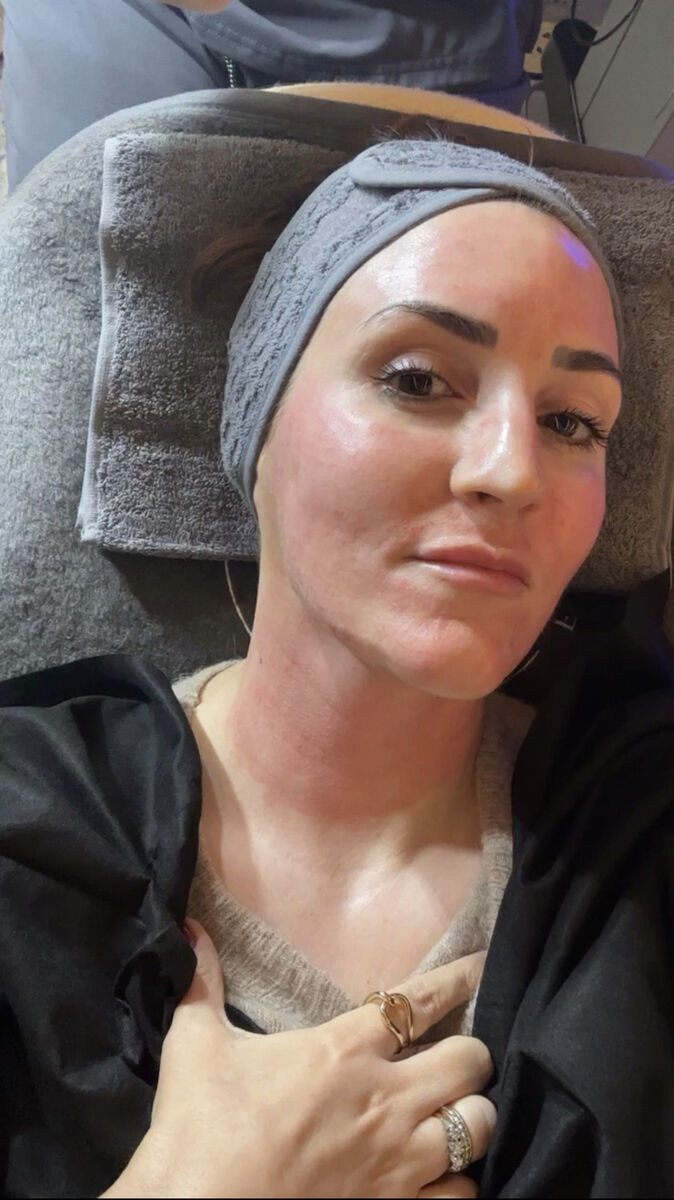 Simone immediately after treatment