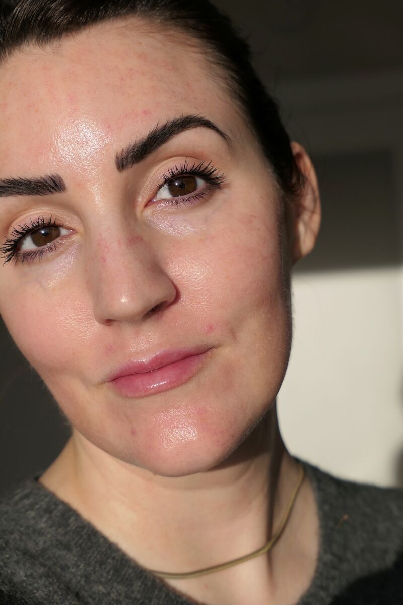  Day two after treatment