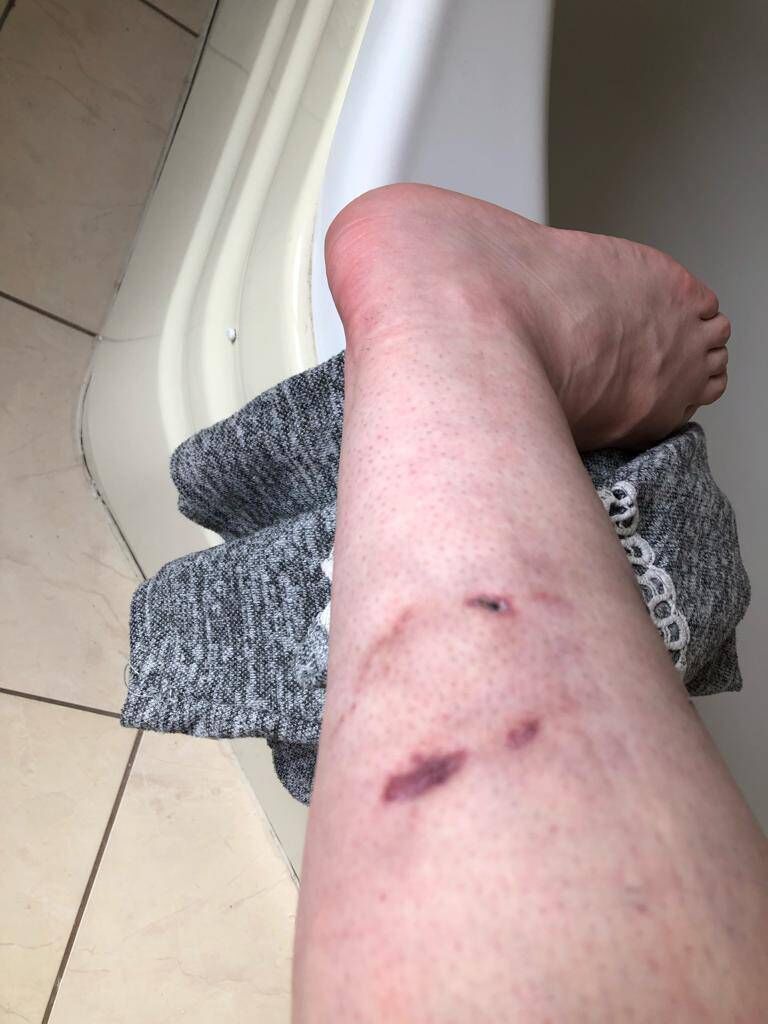 Trina O'Dea: "I have permanent scar damage to my left leg. I don’t have feeling in part of my calf, I still have the teeth marks."