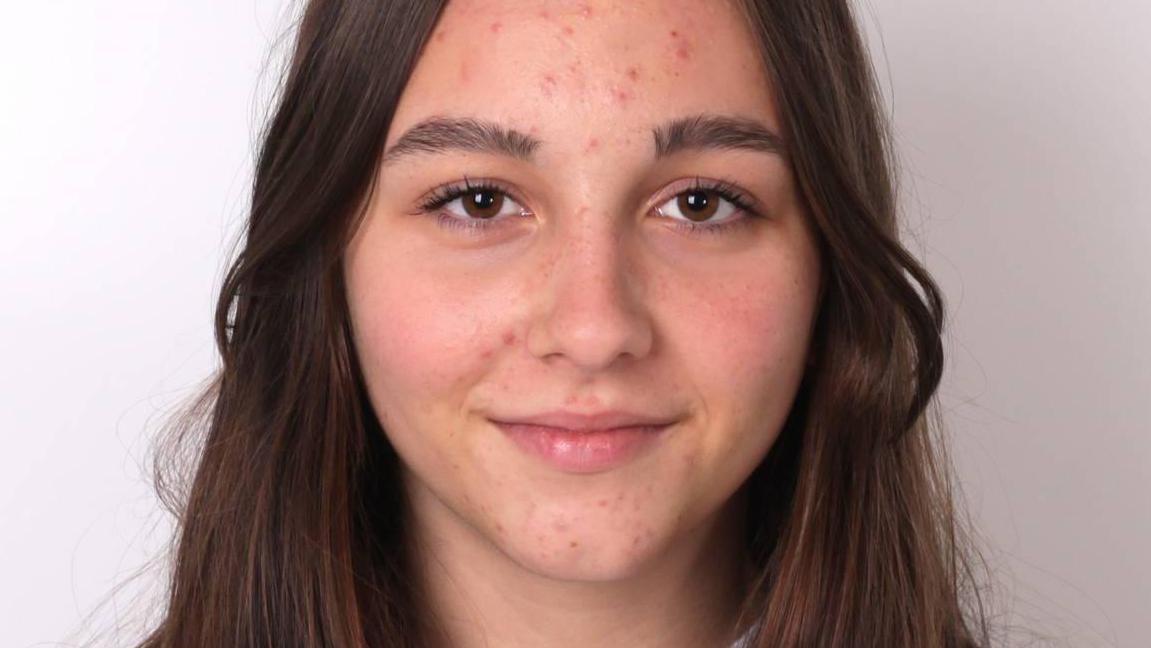 Dr Phil Kieran: Is my teenage daughter's acne due to a hormonal imbalance?