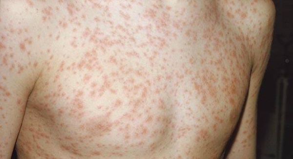 18 of 20 measles victims unvaccinated