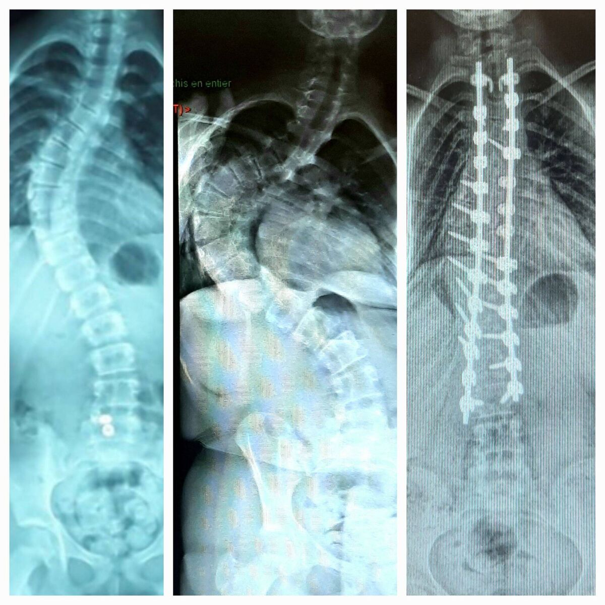 A montage of Xrays from Loanne Ward; June 2020 at diagnosis of scoliosis, September 2021 during pre-op, and July 2022. A montage of Xrays from Loanne Ward; June 2020 at diagnosis of scoliosis, September 2021 during pre-op, and July 2022.