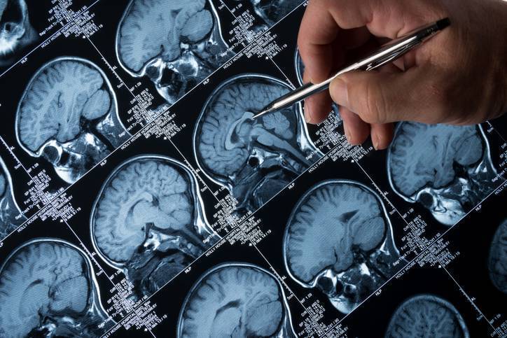 ‘Turning point in the fight against Alzheimer’s’ as drug found to slow disease