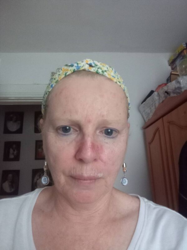 Deirdre Bonass from Wexford is one of 13,000 people diagnosed with skin cancer in Ireland every year. Deirdre Bonass from Wexford is one of 13,000 people diagnosed with skin cancer in Ireland every year.