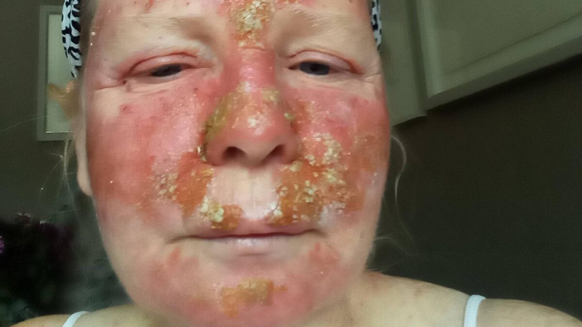 Mother shows impact of skin cancer to persuade others to be sun safe - Vimarsana News