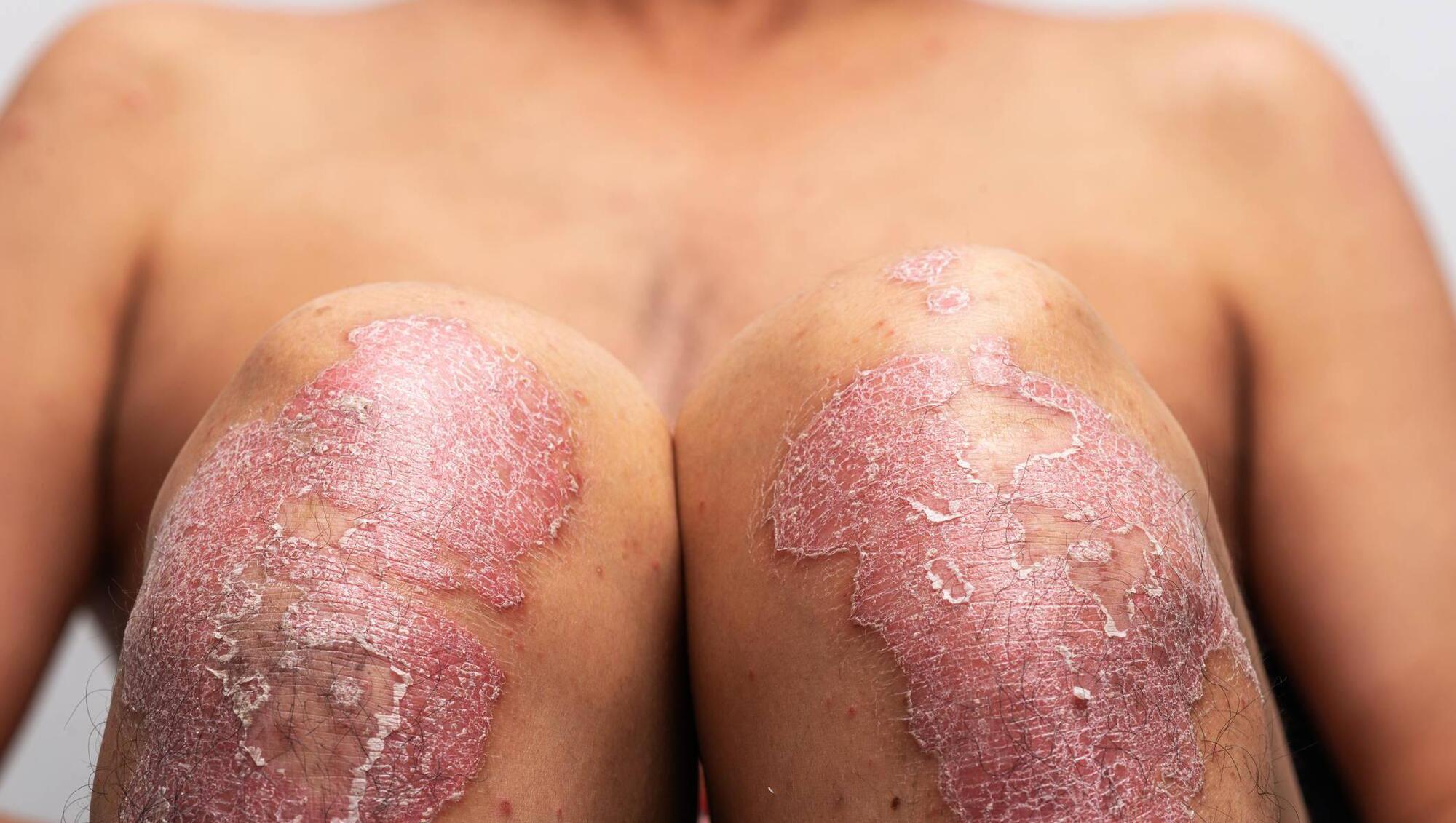 The Skin Nerd: What you need to know about psoriasis and how to manage it