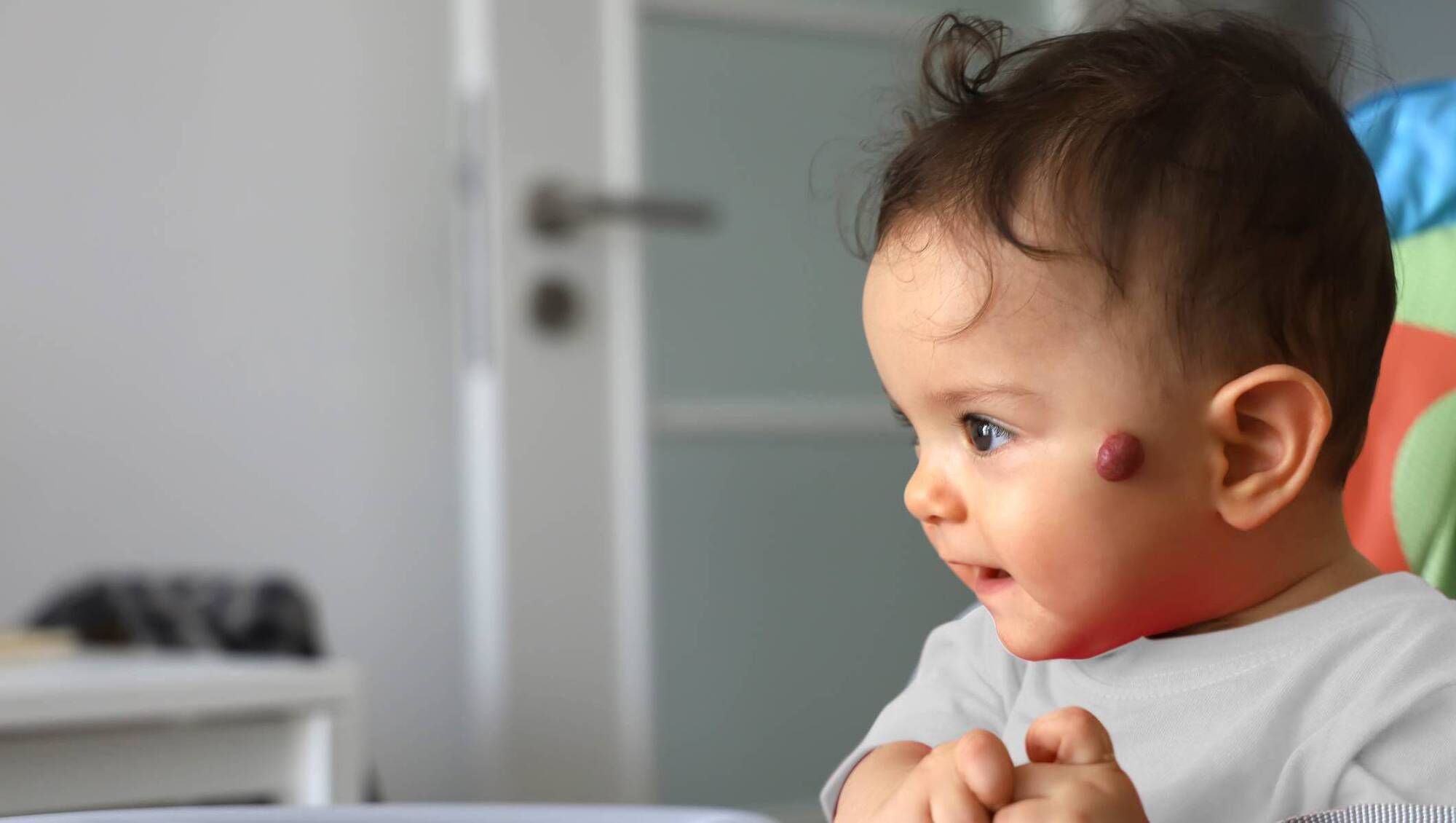 Dr Phil Kieran: My six-month-old has a strawberry mark on his face