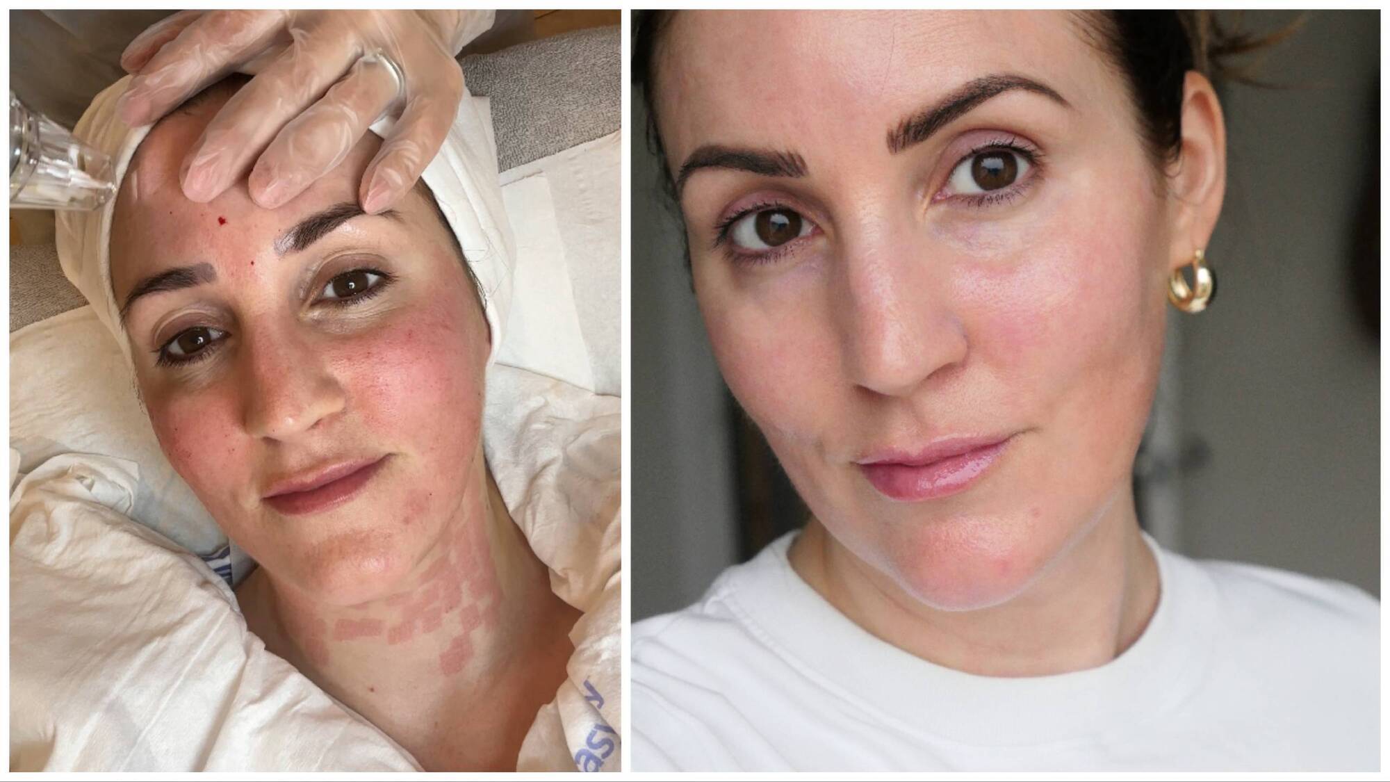 Simone Gannon: I tried Potenza RF Microneedling, the €500 skin treatment with excellent results