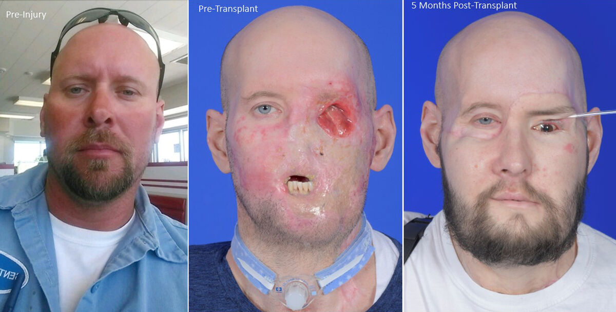 This combination of photos provided by NYU Langone Health in November 2023 shows Aaron James before and after his high-voltage electricity accident and after a facial and eye transplant. Picture: NYU Langone Health via AP