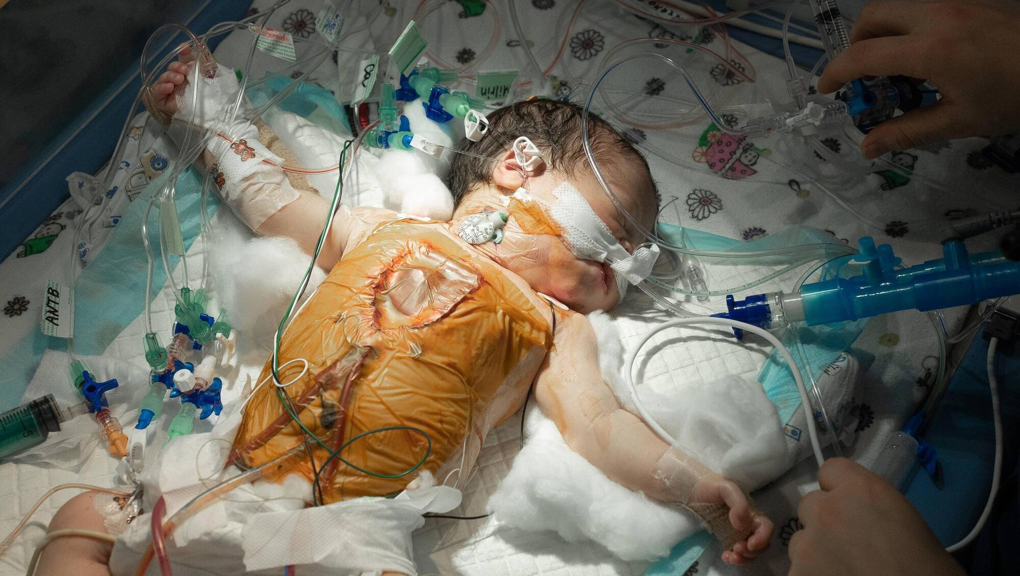 Baby Khrystina is now in recovery from surgery. Picture: Chernobyl Children International 