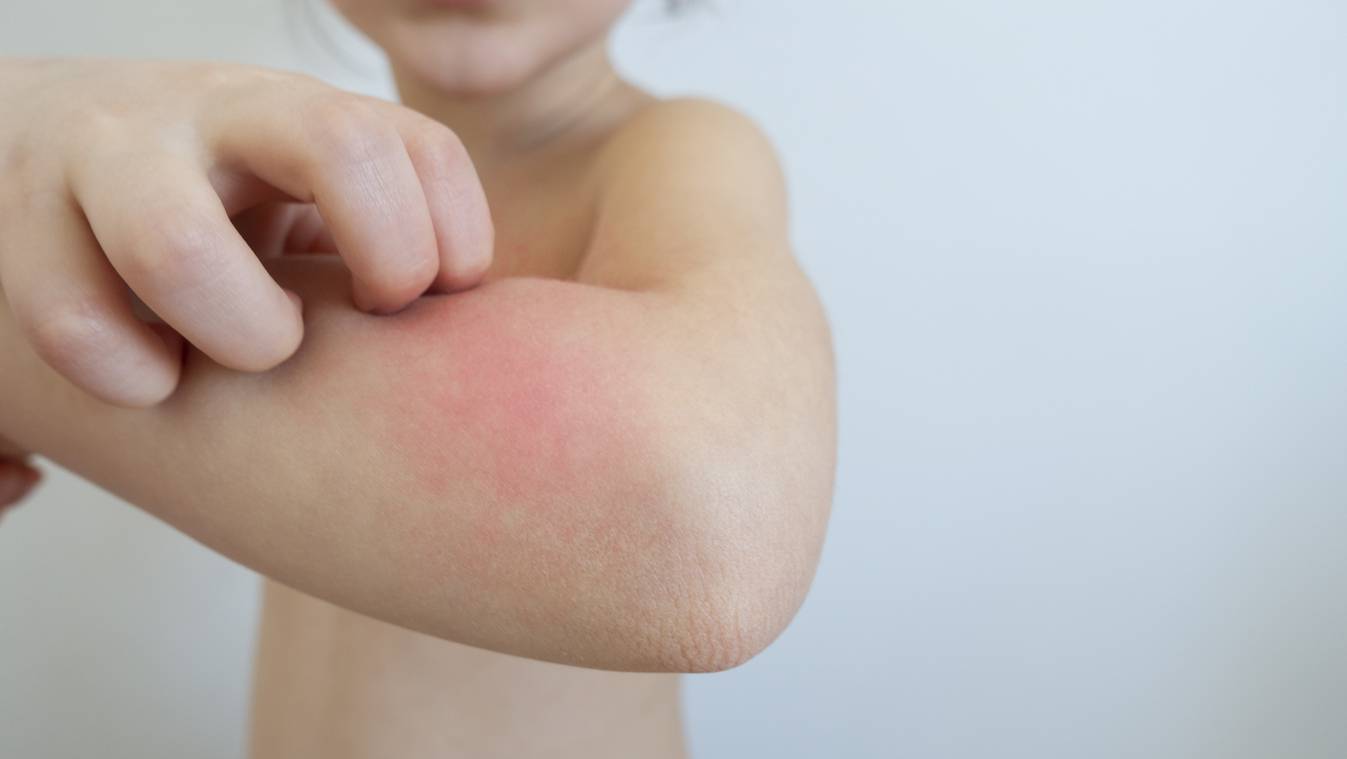 Dr Phil Kieran: I'm worried my children will get scabies