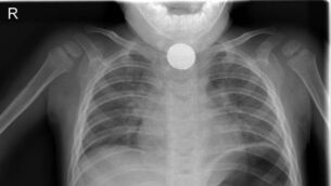 <p> Aaron Sikorski (6) from Tuam Co Galway who settled a High Court action over care he received after he swallowed a button battery when he was one years of age.</p>