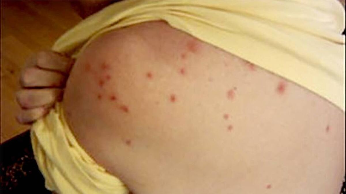 Measles: HSE urges parents to ensure children get MMR jab amid surge in cases - Vimarsana News