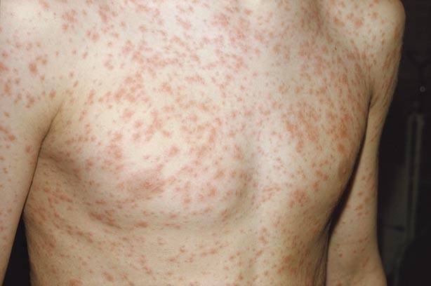 Second case of measles is confirmed in Ireland