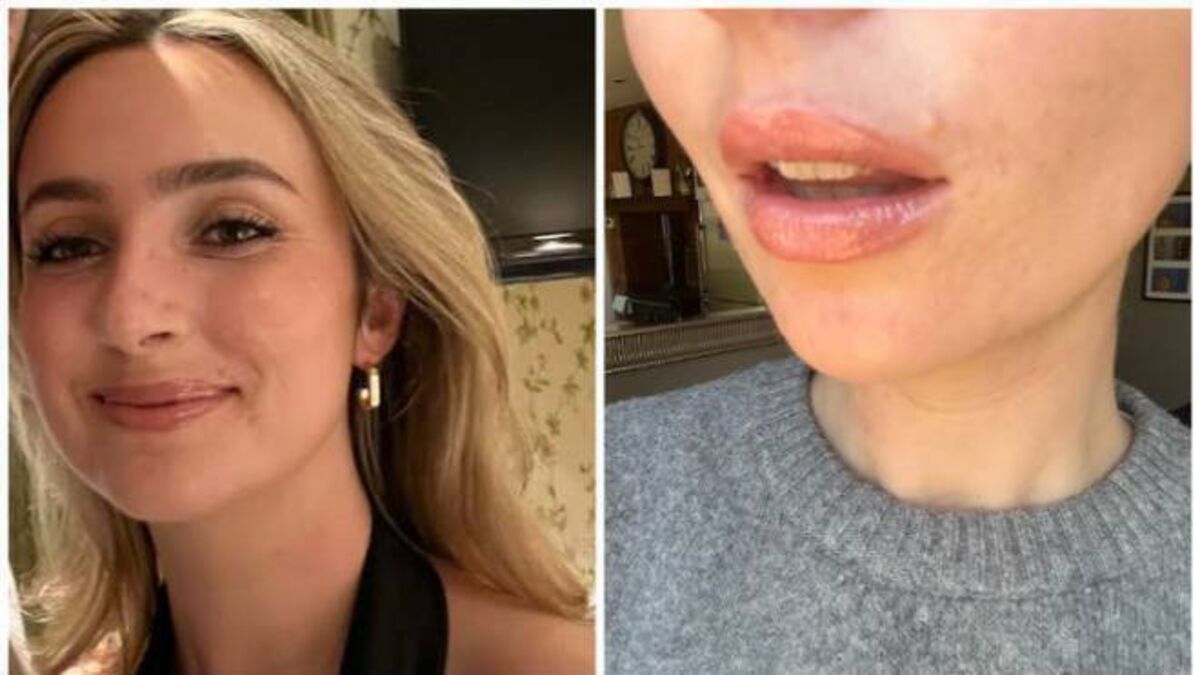 What is a lip flip? We got one – here's what happened - Vimarsana News