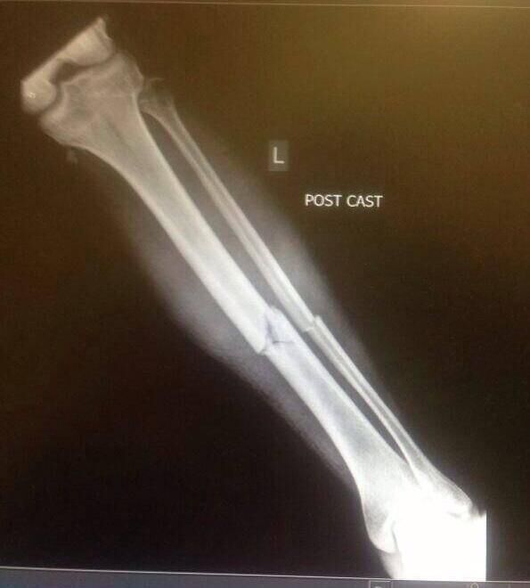 The x-ray of Paudie O'Sullivans broken leg. The x-ray of Paudie O'Sullivans broken leg.