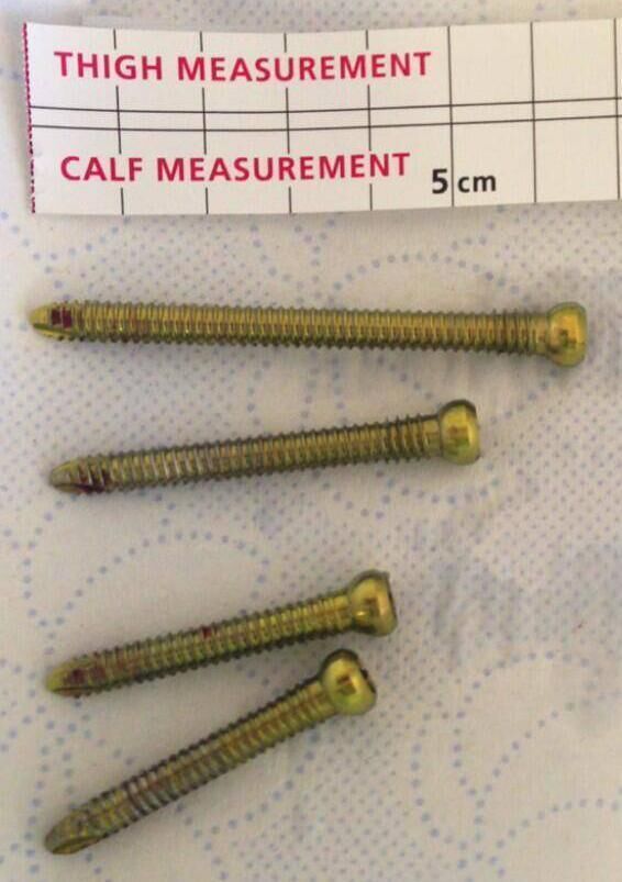 The four screws which were inserted into Paudie O'Sullivan's leg. The four screws which were inserted into Paudie O'Sullivan's leg.
