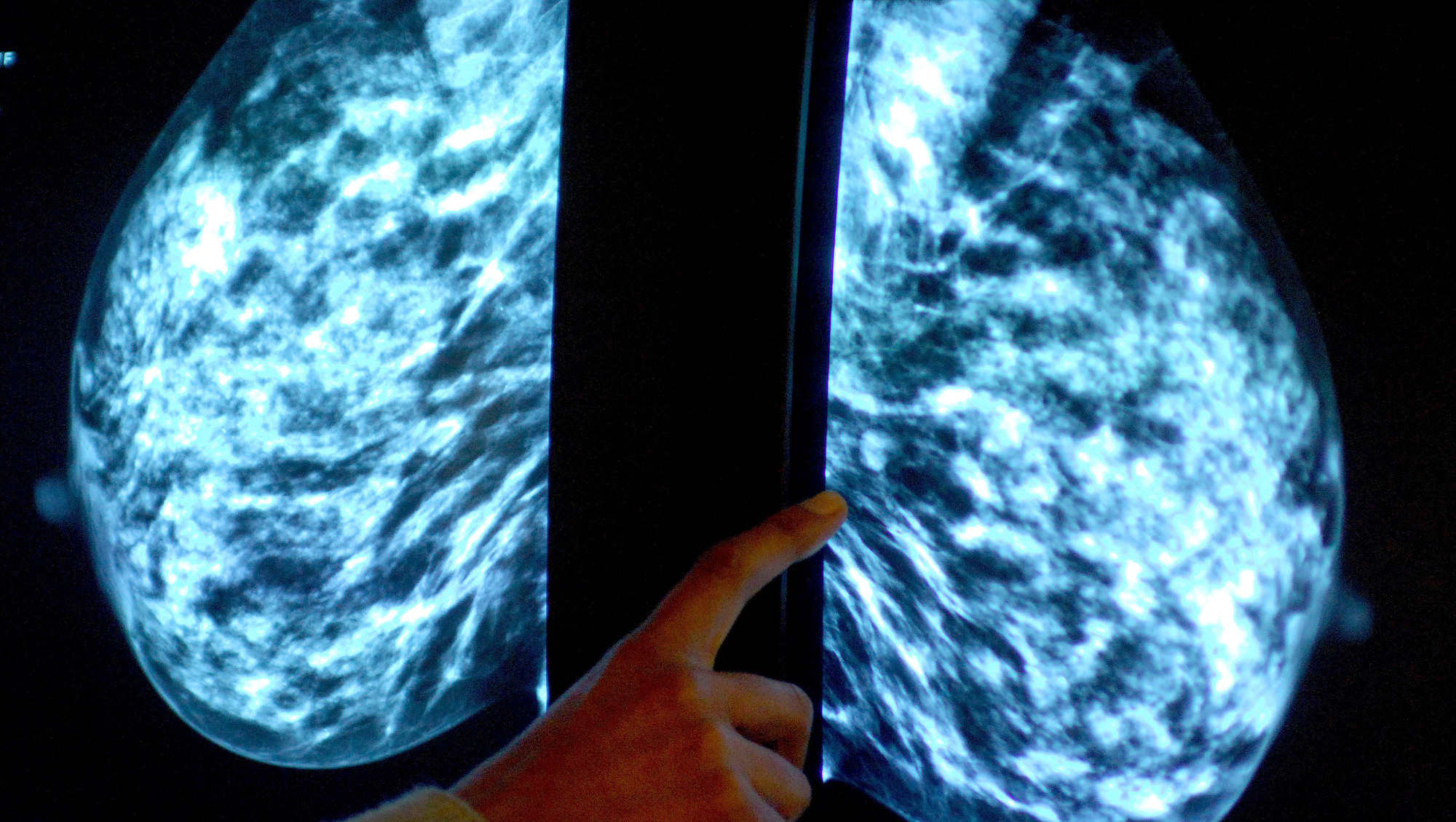 Preserving breast tissue outside of body will aid cancer research – study
