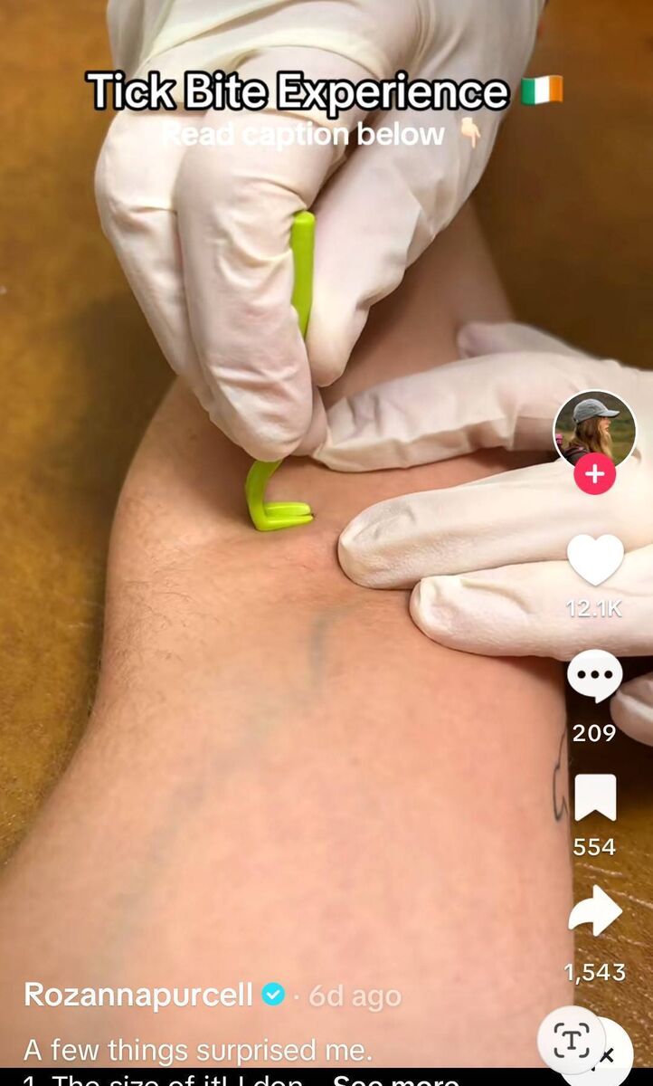 Rozanna Purcell describes having a tiny tick removed after a hike recently. Picture: @rozannapurcell