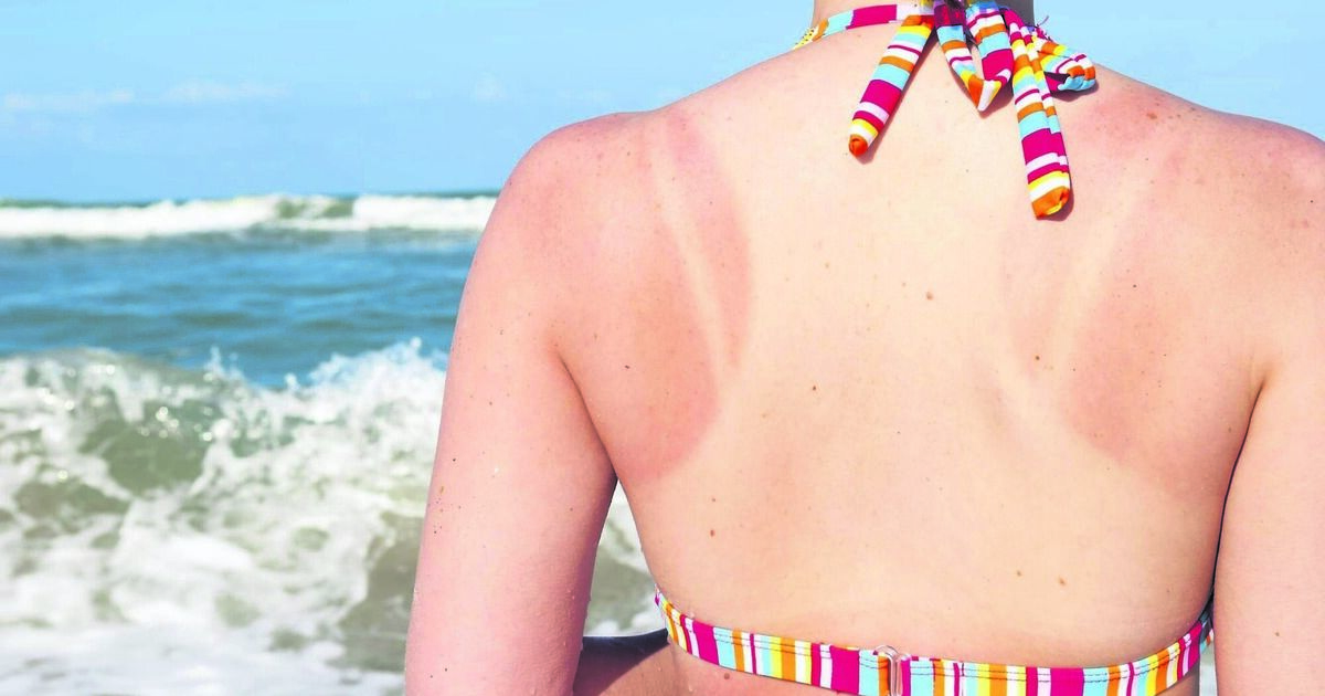 Burning issue: Young people think that skin cancer only happens to older ...