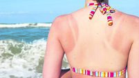 Sunburned woman at beach