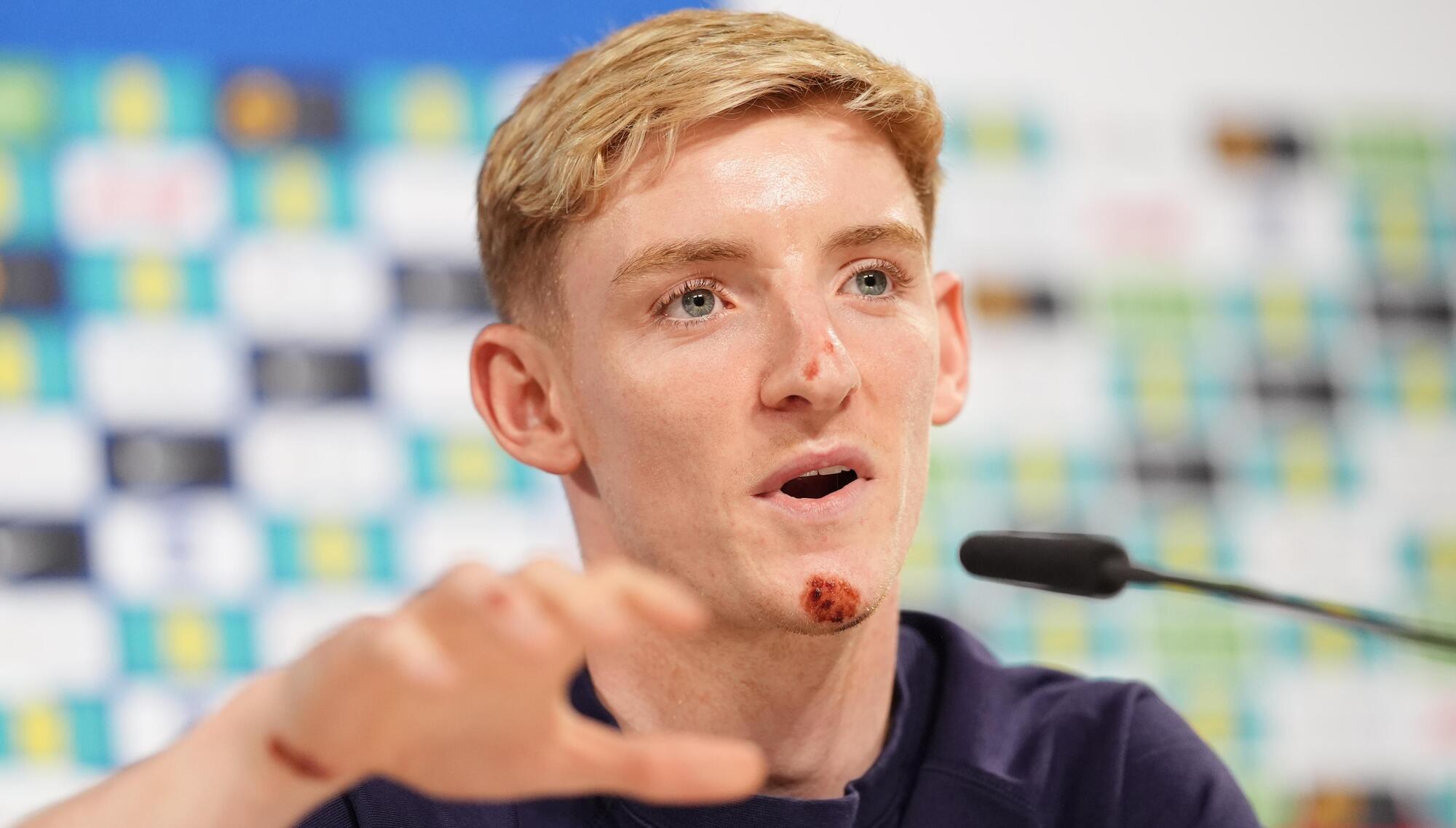 Anthony Gordon takes team-mates’ jokes on the chin after bike accident