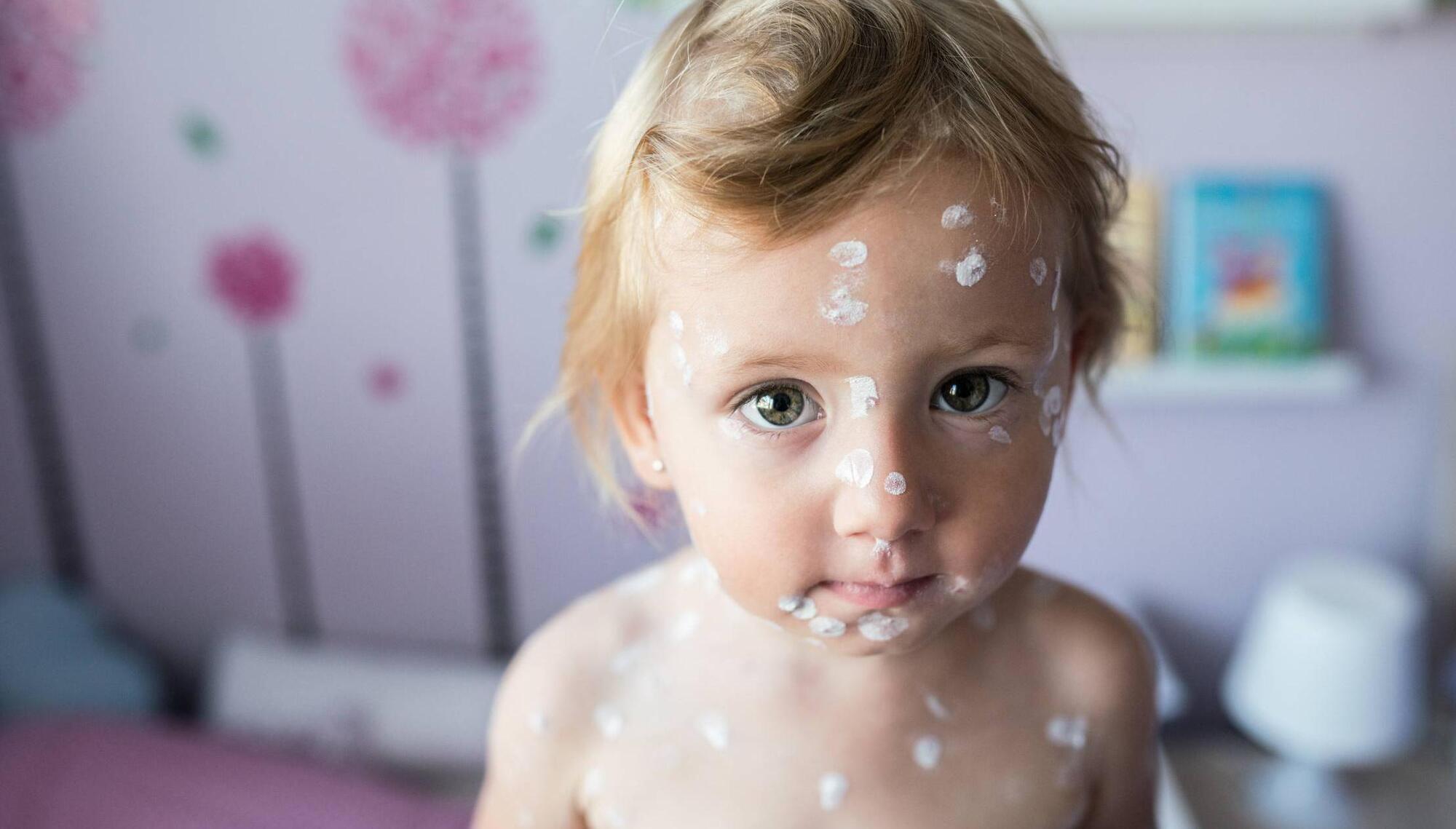 Chickenpox: How it's spreading, why it needs immediate medical care, and how to spot it
