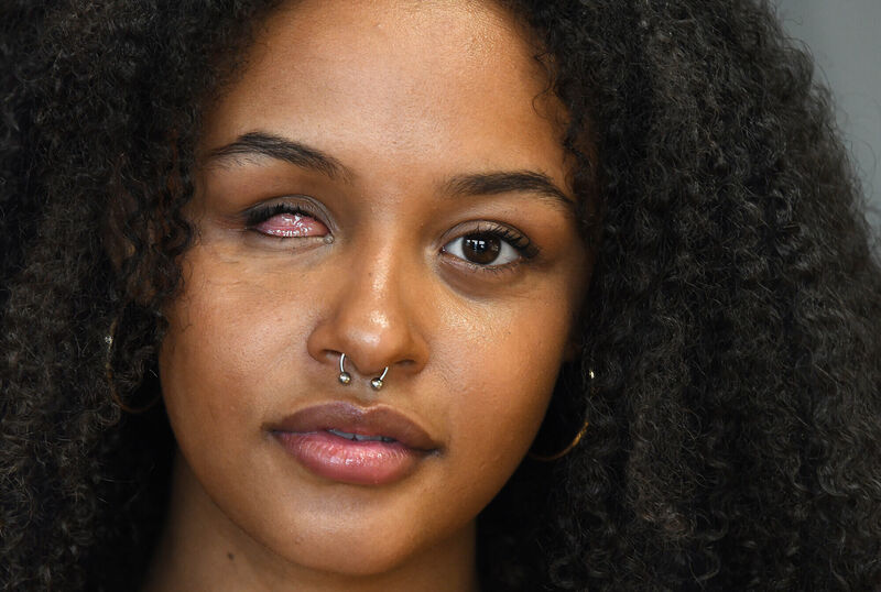  Alanna Quinn Idris lost the sight in her right eye in December 2021, following a serious assault on Ballyfermot Rd. Picture: Moya Nolan