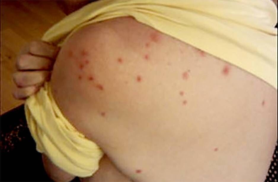 Measles is often associated with a rash, but the virus can spread around the body, potentially leading to severe complications, and in some cases death.