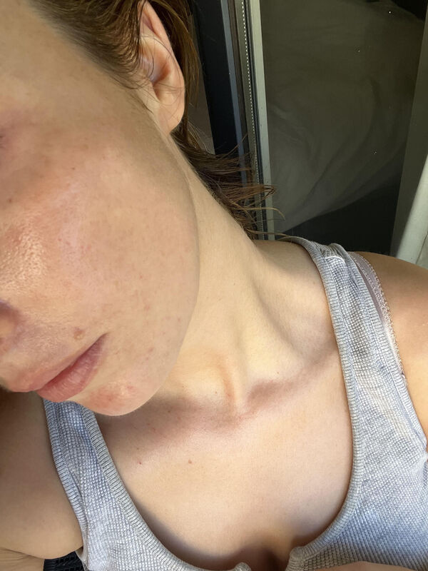 Kate Demolder, one week after treatment