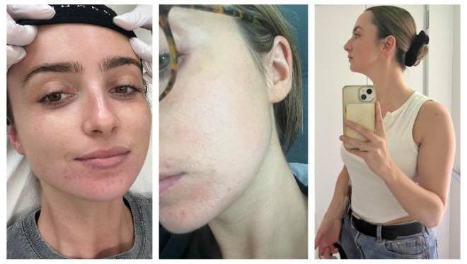 Morpheus8 review: Is this €900 beauty treatment worth it?