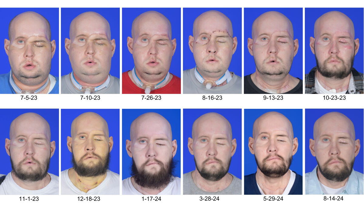 Composite image showing the progress of Aaron James' post-operation recovery: NYU Langone Health/PA Wire
