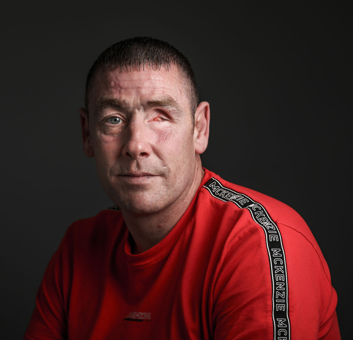 Francis is on the waiting list for surgery, which it is hoped will restructure his eye socket to facilitate a prosthetic eye.