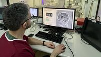 AI could help detect epilepsy-linked brain lesions that are often missed – study