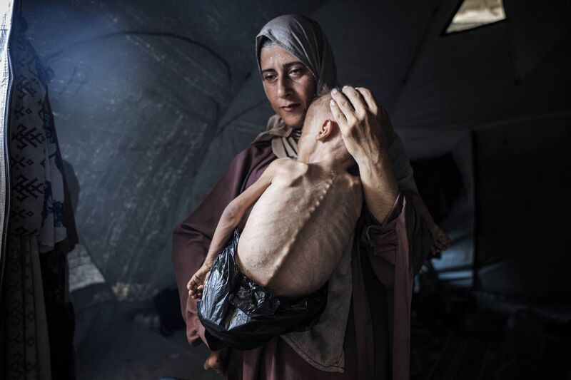 Muhammad Zakariya Ayyoub al-Matouq, a 18-month-old child faces life-threatening malnutrition as the humanitarian situation worsens due to ongoing Israeli attacks and blockade. Having dropped from nine to six kilograms, he struggles to survive in a tent in Gaza City, where milk, food, and other basic necessities are lacking. Photo: Ahmed Jihad Ibrahim Al-arini/Anadolu via Getty Images