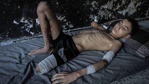 <p>Eleven-year-old Samir Muhammed Samir Zekut fighting for his life due to insufficient treatment after being seriously injured in an Israeli attack on a house in Sheikh Radwan, Gaza in May. Picture: Ahmed Jihad Ibrahim Al-arini/Anadolu/Images </p>