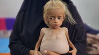 Children suffering from malnutrition in Gaza receive treatment under limited conditions