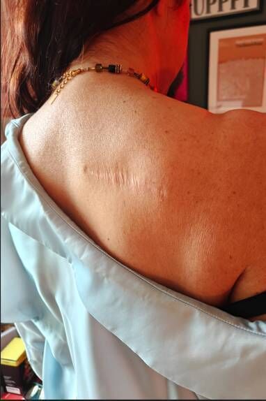 In 2016, a friend spotted a mole on Gill Costelloe's back. This turned out to be Stage One melanoma and was removed.