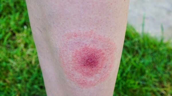 A Lyme disease rash. File image A Lyme disease rash. File image