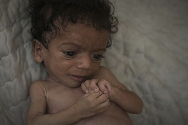 Seven-month-old Salem Awad, suffering from severe malnutrition, lies on a mattress in his family's tent in Gaza City in July. Picture: AP /Jehad Alshrafi Seven-month-old Salem Awad, suffering from severe malnutrition, lies on a mattress in his family's tent in Gaza City in July. Picture: AP /Jehad Alshrafi