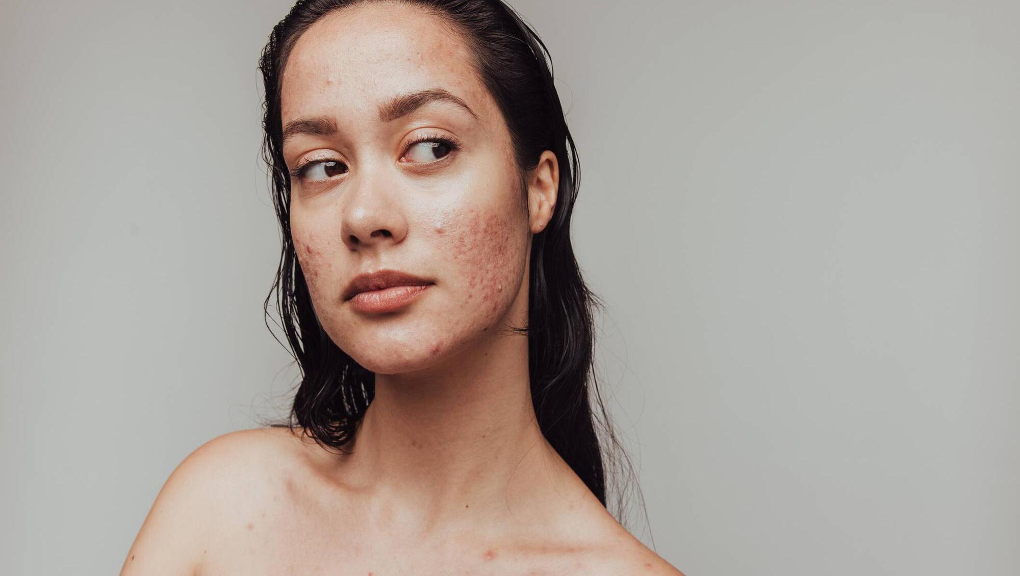 Natural health: What can I do about my adult acne? 