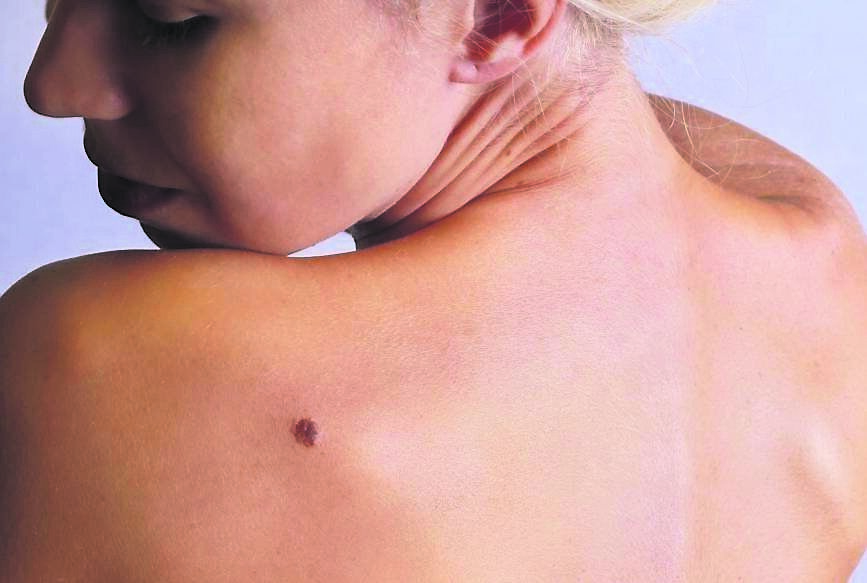 Skin cancer is Ireland’s most common cancer, with approximately 11,000 cases diagnosed every year. Picture: iStock
