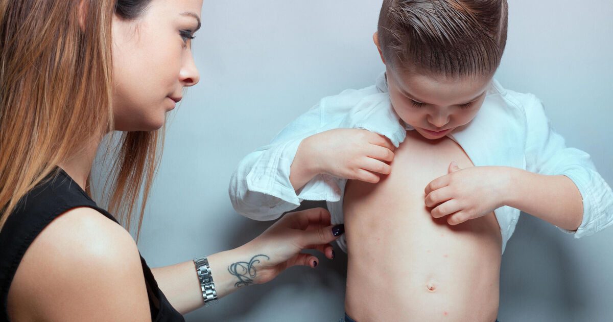 Irish Examiner view: We need to keep vaccinating amid measles outbreaks