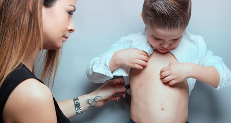 Little boy with measles