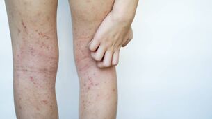 <p>Eczema is characterised by a dry, itchy, sometimes flaky rash. It can occur on any skin but is most common in areas where the skin bends (flexures), such as the insides of the elbows and behind the knees. Picture: iStock </p>