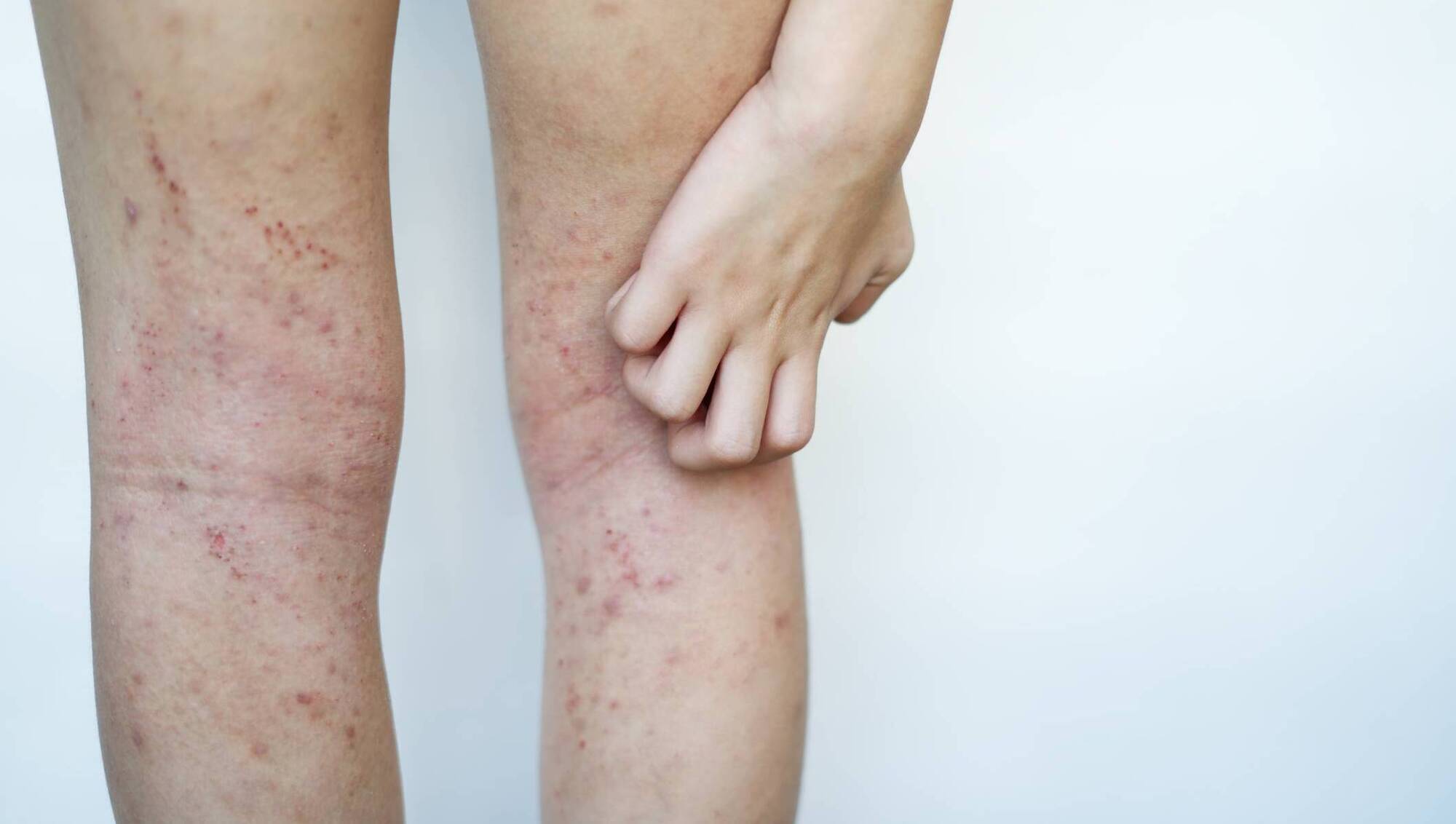 Dr Phil Kieran: My son's childhood eczema is back and it's painful