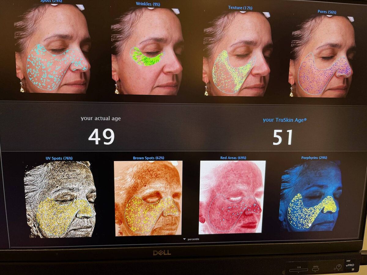 Vickie's first Visia reading results