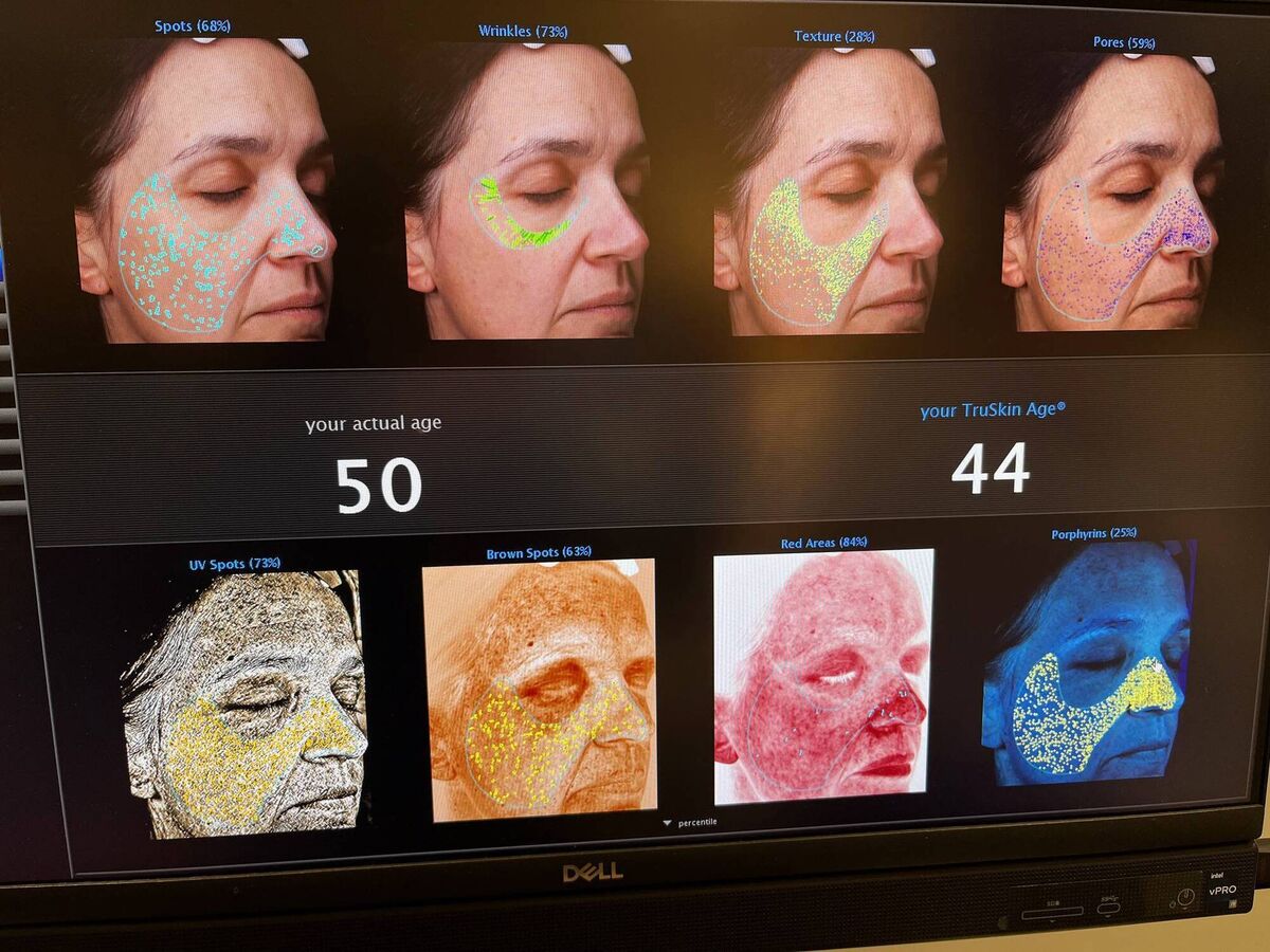 Vickie's Visia results after four months of treatment